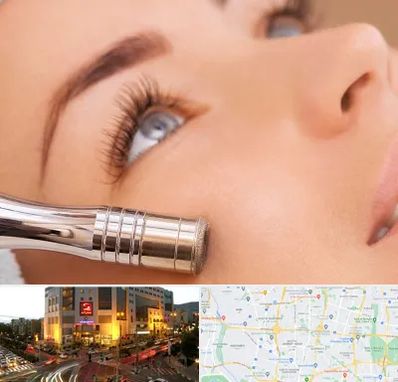 میکرودرم در جنت آباد تهران 