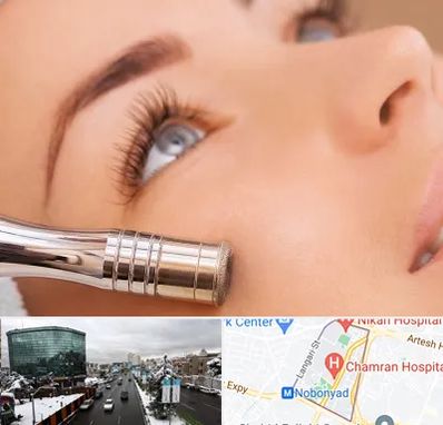 میکرودرم در اقدسیه 