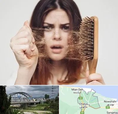 دکتر ریزش مو در چالوس