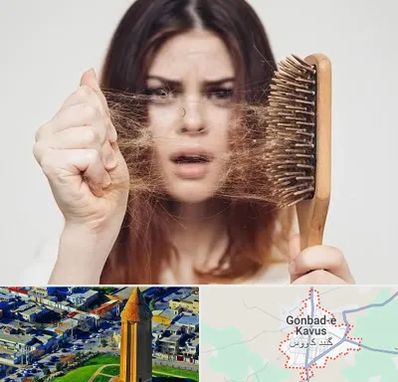 دکتر ریزش مو در گنبد کاووس