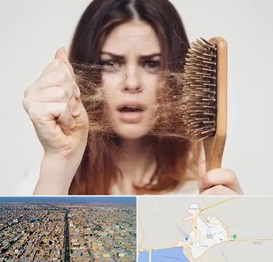 دکتر ریزش مو در بندر ماهشهر