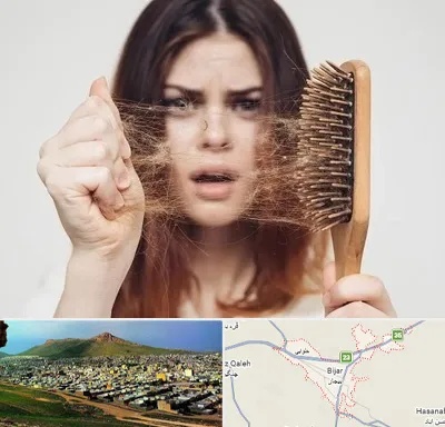 دکتر ریزش مو در بیجار