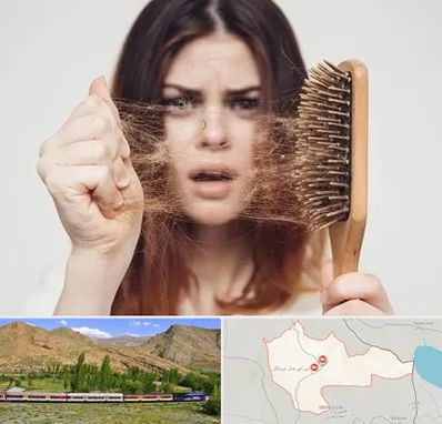 دکتر ریزش مو در خاش