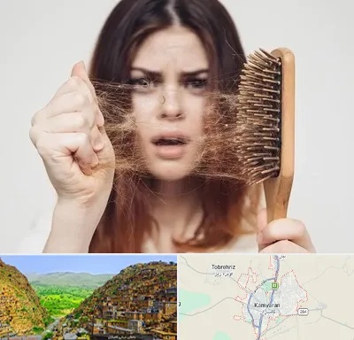 دکتر ریزش مو در کامیاران