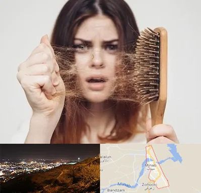 دکتر ریزش مو در میناب
