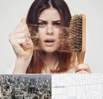 دکتر ریزش مو در جیحون