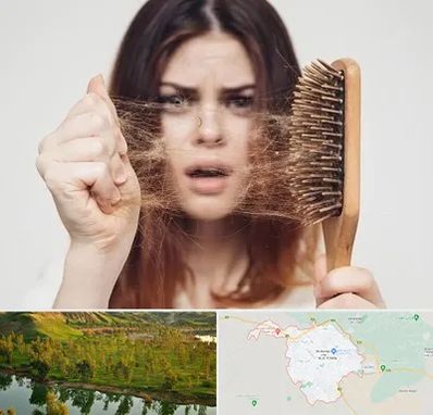 دکتر ریزش مو در بهبهان