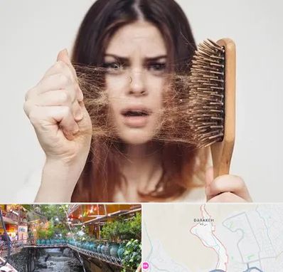 دکتر ریزش مو در درکه