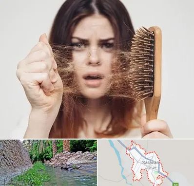 دکتر ریزش مو در سراوان