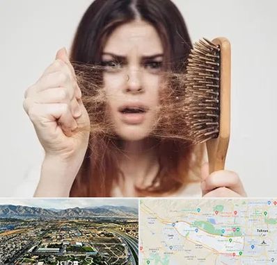 دکتر ریزش مو در منطقه 21 تهران 