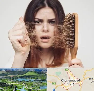 دکتر ریزش مو در خرم آباد