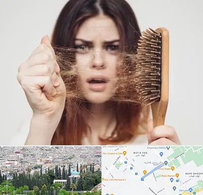 دکتر ریزش مو در محلاتی شیراز