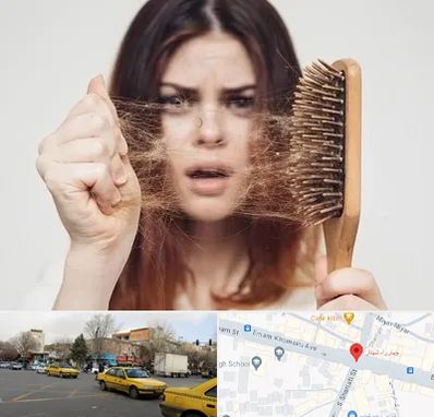 دکتر ریزش مو در شهناز تبریز