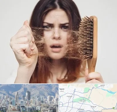 دکتر ریزش مو در شمال شرق تهران