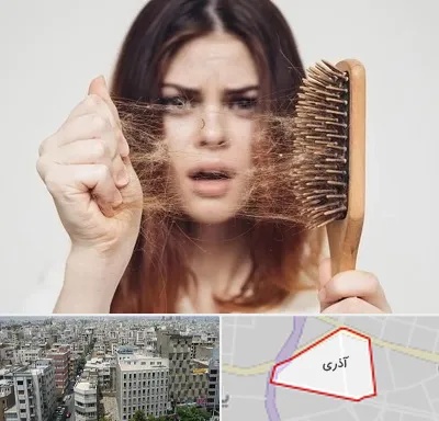 دکتر ریزش مو در آذری