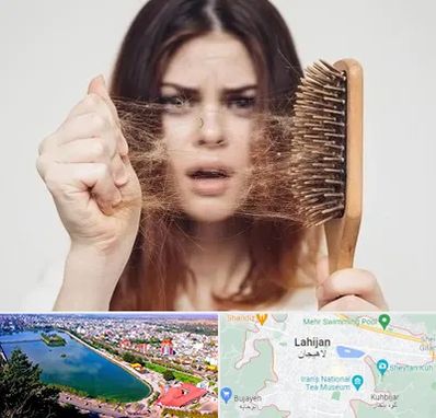 دکتر ریزش مو در لاهیجان