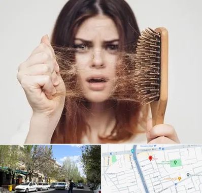 دکتر ریزش مو در کوی فیروز تبریز