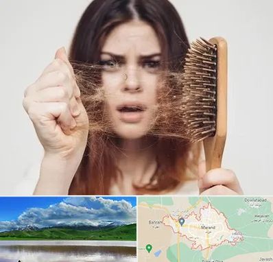 دکتر ریزش مو در مرند