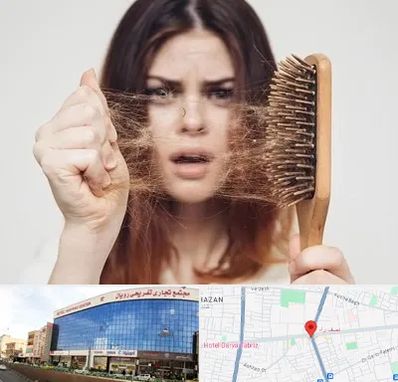 دکتر ریزش مو در نصف راه تبریز