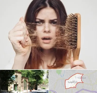 دکتر ریزش مو در دزاشیب