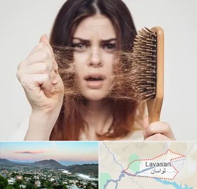 دکتر ریزش مو در لواسان