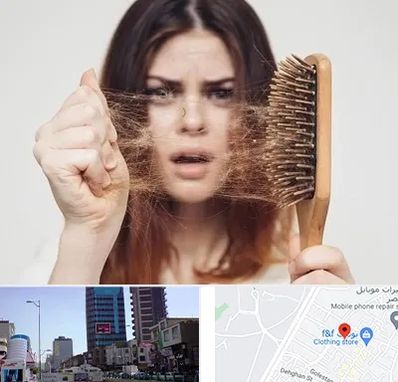 دکتر ریزش مو در چهارراه طالقانی کرج