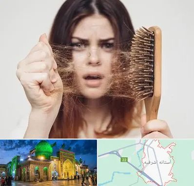 دکتر ریزش مو در آستانه اشرفیه