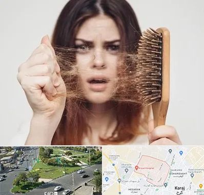 دکتر ریزش مو در شاهین ویلا کرج