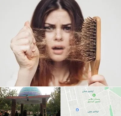 دکتر ریزش مو در کیانشهر