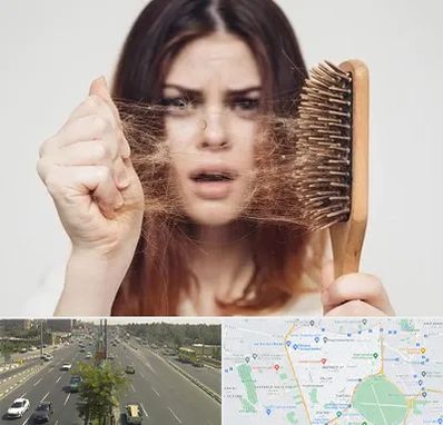 دکتر ریزش مو در منطقه 17 تهران 