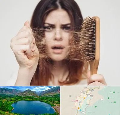 دکتر ریزش مو در رودبار