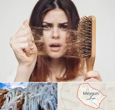 دکتر ریزش مو در میگون