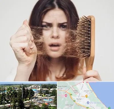 دکتر ریزش مو در رودسر