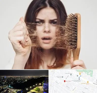 دکتر ریزش مو در هفت تیر مشهد