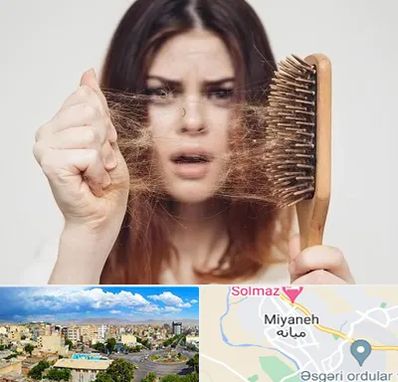 دکتر ریزش مو در میانه