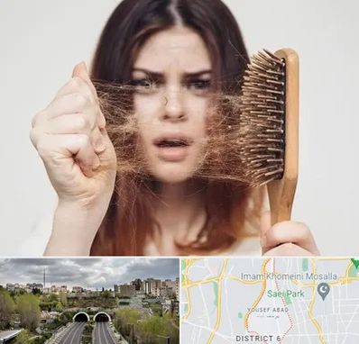 دکتر ریزش مو در یوسف آباد 