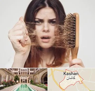 دکتر ریزش مو در کاشان