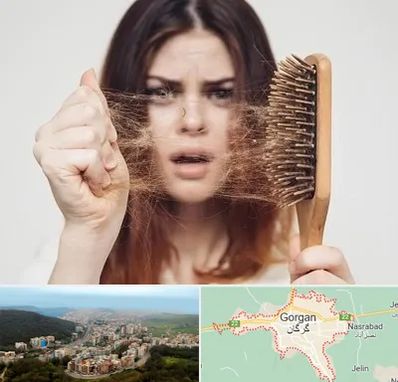 دکتر ریزش مو در گرگان