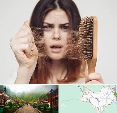 دکتر ریزش مو در فومن