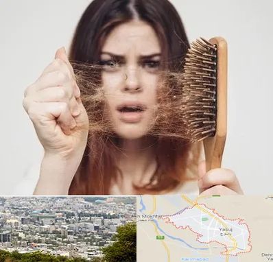 دکتر ریزش مو در یاسوج