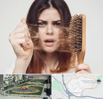 دکتر ریزش مو در مرزداران تبریز