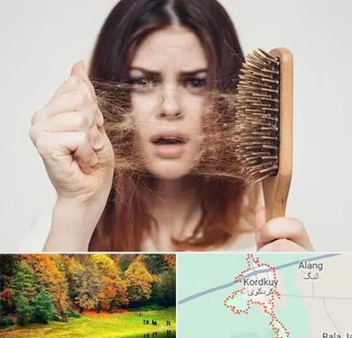 دکتر ریزش مو در کردکوی