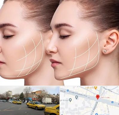 جراحی بوکال فت در شهناز تبریز