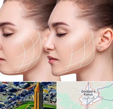 جراحی بوکال فت در گنبد کاووس