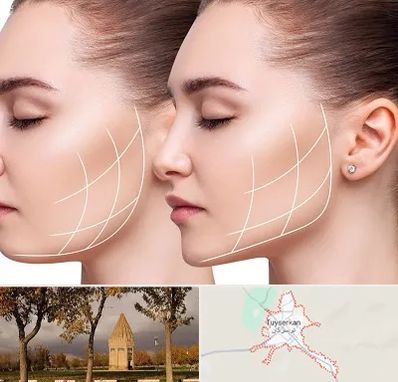 جراحی بوکال فت در تویسرکان