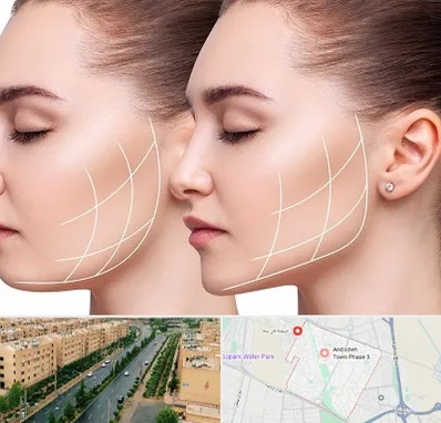 جراحی بوکال فت در فاز سه اندیشه