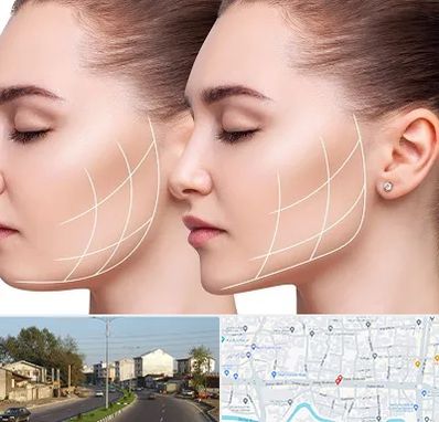 جراحی بوکال فت در ضیابری رشت