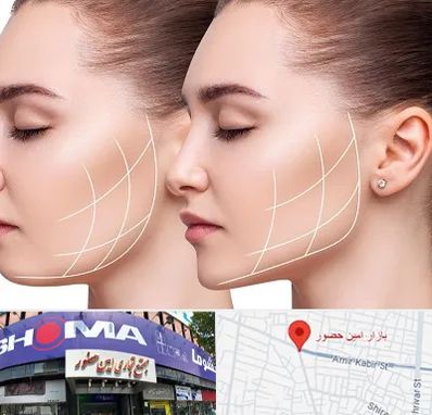 جراحی بوکال فت در امین حضور