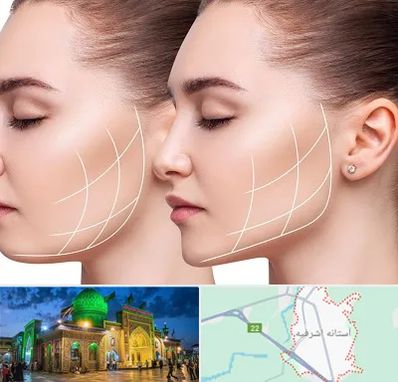 جراحی بوکال فت در آستانه اشرفیه