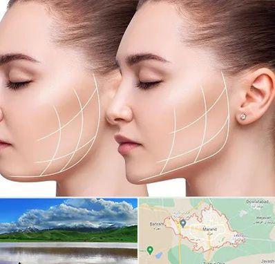 جراحی بوکال فت در مرند